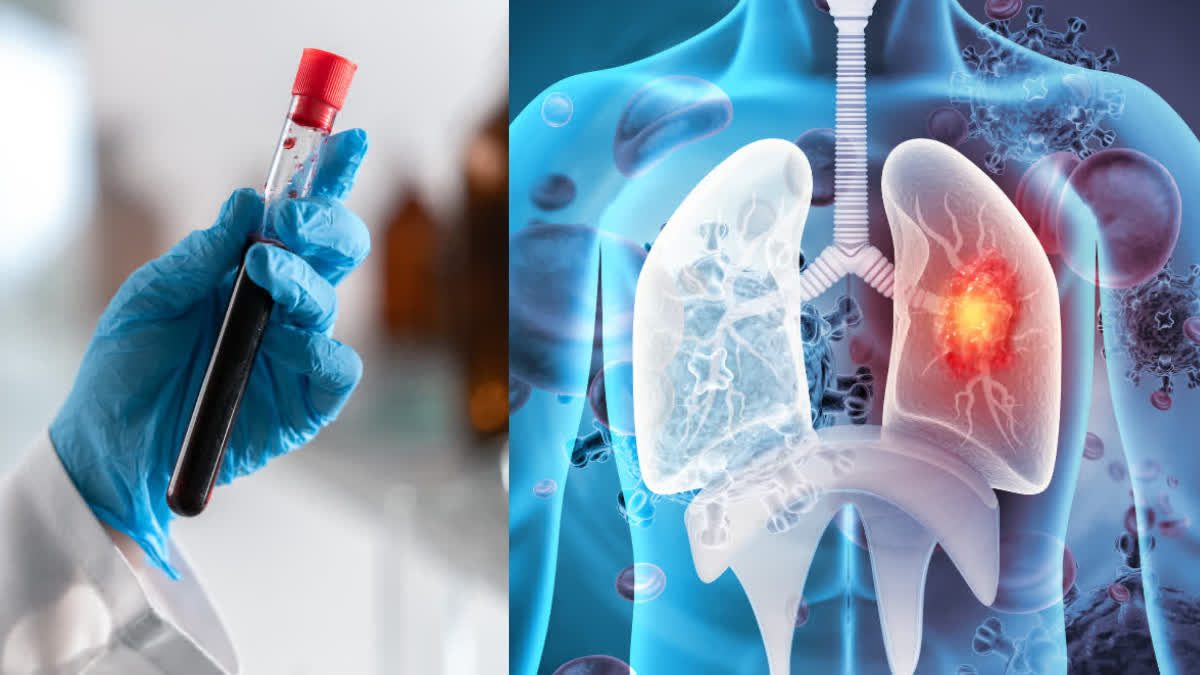 New Blood Test Detects Lung Cancer Up to Five Years Before Symptoms Appear